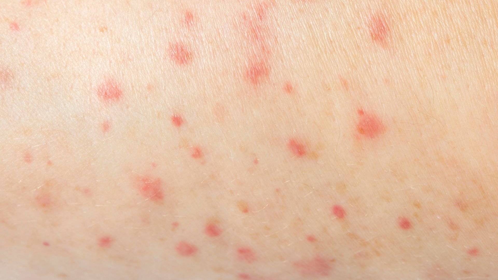 A medida tem caráter preventivo e de emergência diante dos casos confirmados nas regiões próximas à Araguaína. Até o momento, nenhum quadro suspeito deu entrada nas unidades. (Foto: Freepik)